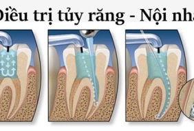 ĐIỀU TRỊ NỘI NHA