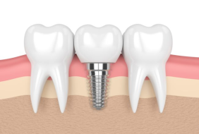 CẤY RĂNG IMPLANT