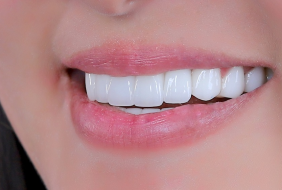 RĂNG SỨ THẨM MỸ 