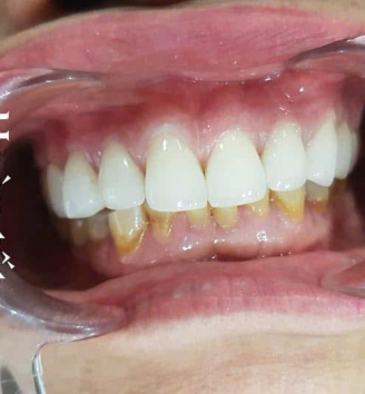 Case làm sứ thẩm mỹ
