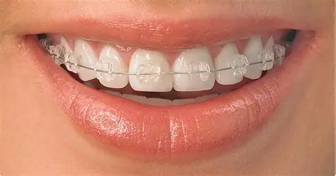 Niềng răng chỉnh nha tại Nha Khoa Hoàng Yến